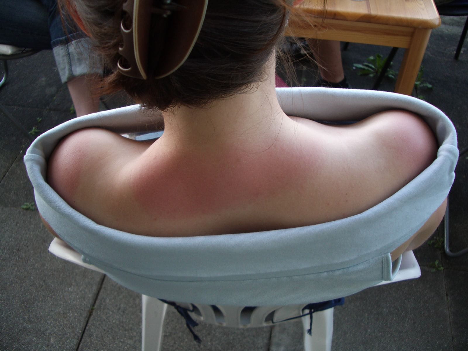 Quemadura solar en la piel tras practicar deporte al aire libre sin protección